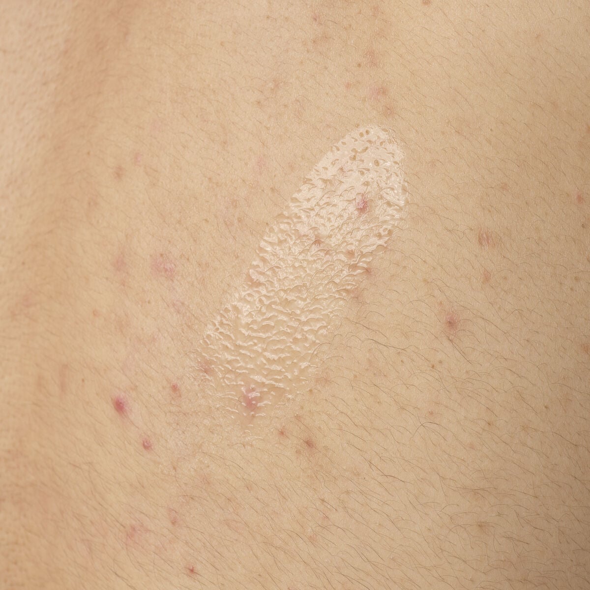 salicylic-acid-0-5-body-serum-c4 ORD-salicylic-acid-05-body-240ml-application.jpg