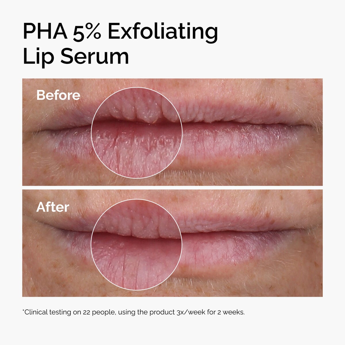 pha-5-exfoliating-lip-serum-y7 ord-pha-5pct-lip-exfoliating-serum-before-after.jpg